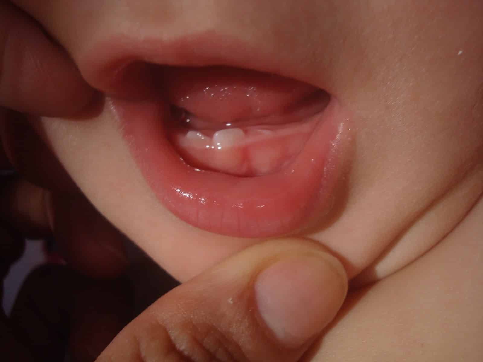 aliviar dores dentes bebe