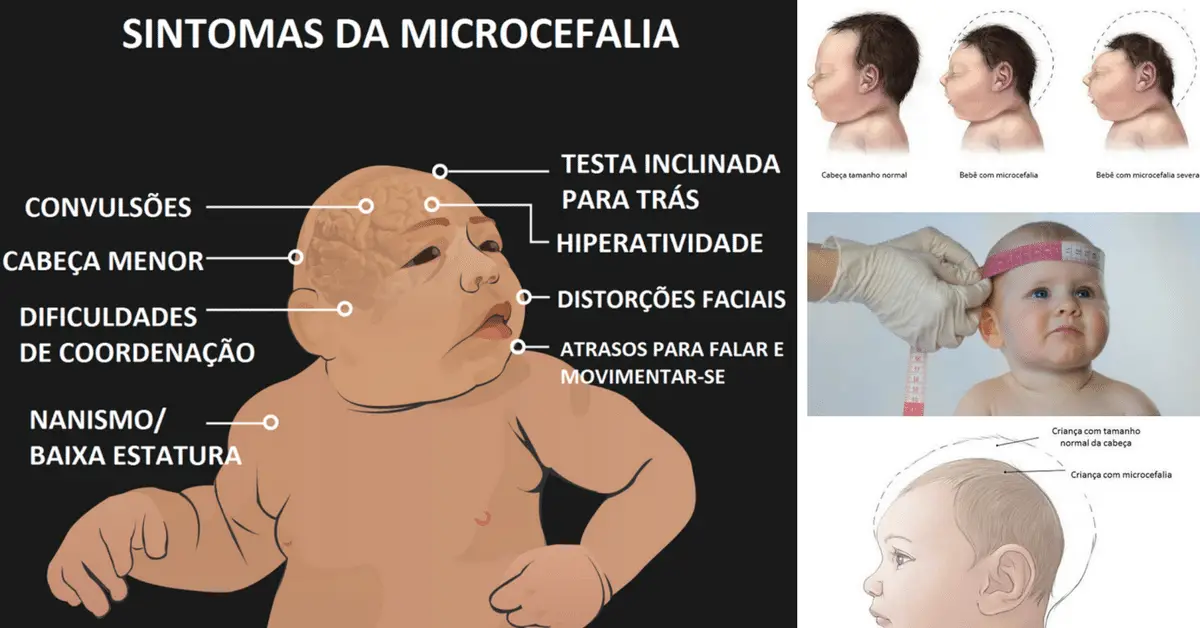 microcefalia